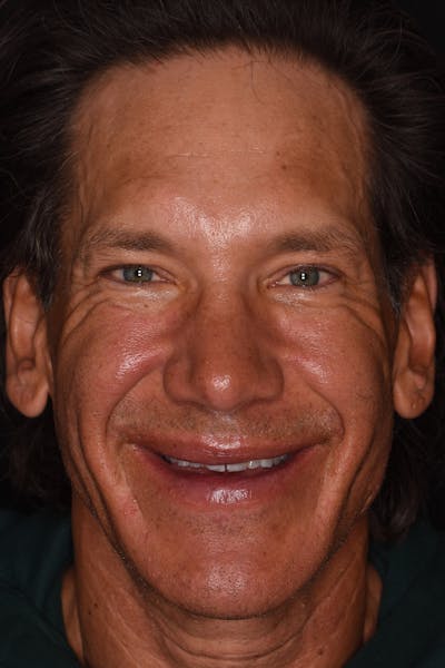 Patient Smile Before & After Gallery - Patient 148640 - Image 1