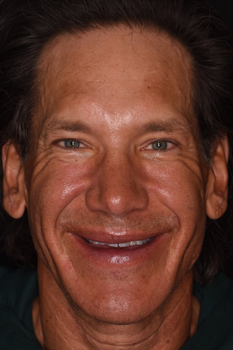 Patient Smile Before & After Gallery - Patient 148640 - Image 1