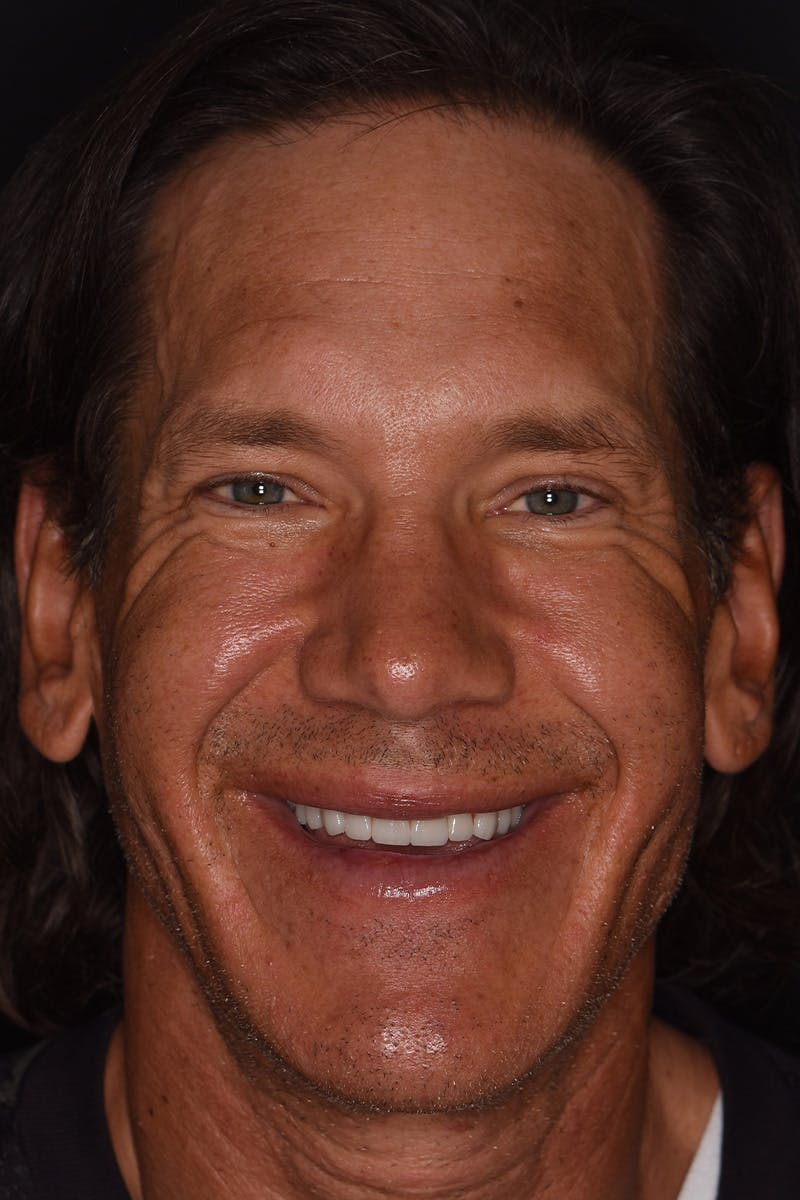Patient Smile Before & After Gallery - Patient 148640 - Image 2