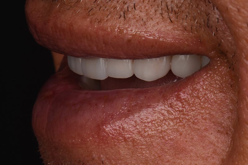 Patient Smile Before & After Gallery - Patient 148640 - Image 6