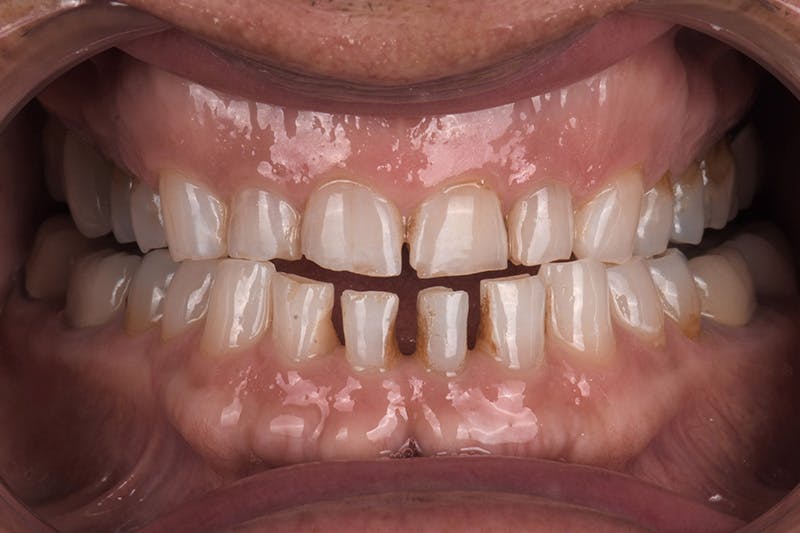 Patient Smile Before & After Gallery - Patient 148640 - Image 3