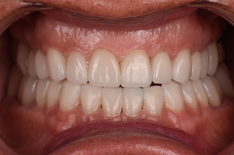 Patient Smile Before & After Gallery - Patient 148640 - Image 4