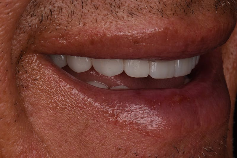 Patient Smile Before & After Gallery - Patient 148640 - Image 8