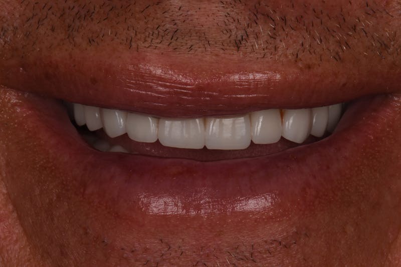 Patient Smile Before & After Gallery - Patient 148640 - Image 10