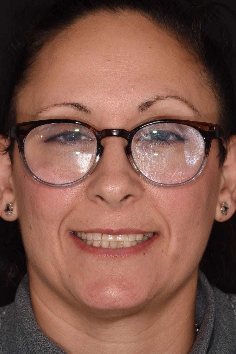 Patient Smile Before & After Gallery - Patient 149217 - Image 1