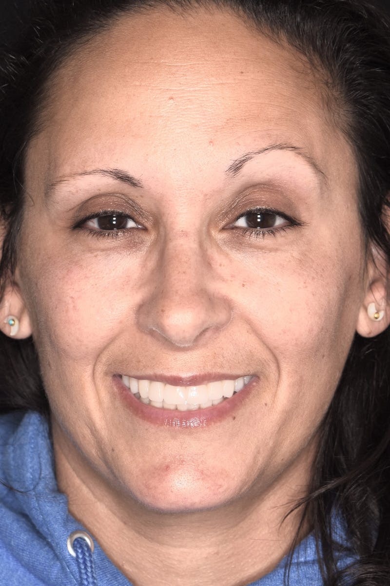 Patient Smile Before & After Gallery - Patient 149217 - Image 2