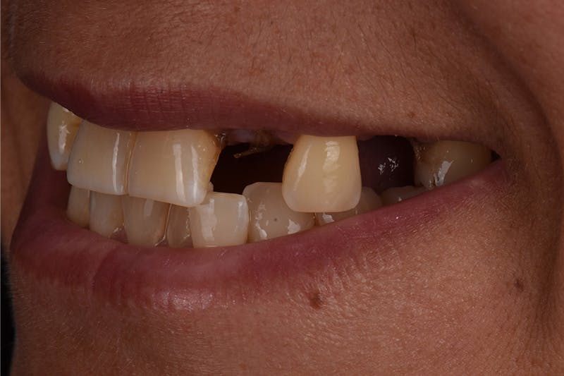 Patient Smile Before & After Gallery - Patient 149217 - Image 7