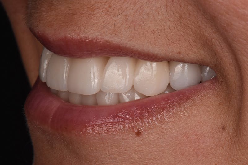 Patient Smile Before & After Gallery - Patient 149217 - Image 8