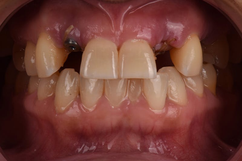 Patient Smile Before & After Gallery - Patient 149217 - Image 3