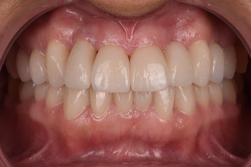 Patient Smile Before & After Gallery - Patient 149217 - Image 4