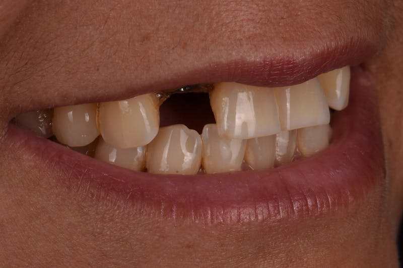 Patient Smile Before & After Gallery - Patient 149217 - Image 9