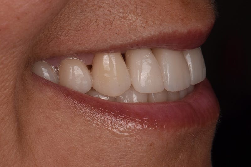Patient Smile Before & After Gallery - Patient 149217 - Image 10