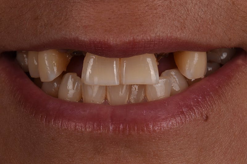 Patient Smile Before & After Gallery - Patient 149217 - Image 5