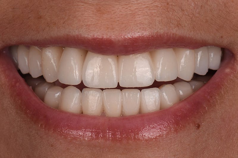 Patient Smile Before & After Gallery - Patient 149217 - Image 6