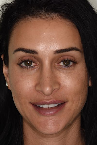 Patient Smile Before & After Gallery - Patient 371725 - Image 1