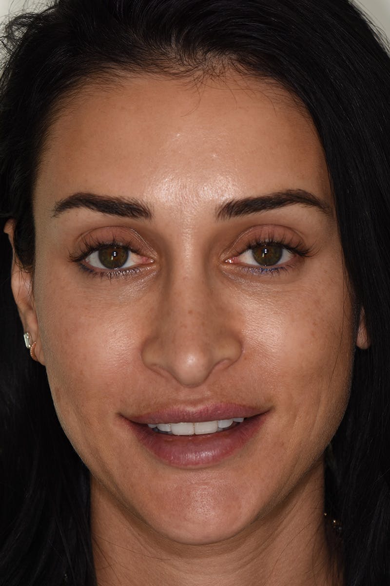 Patient Smile Before & After Gallery - Patient 371725 - Image 1