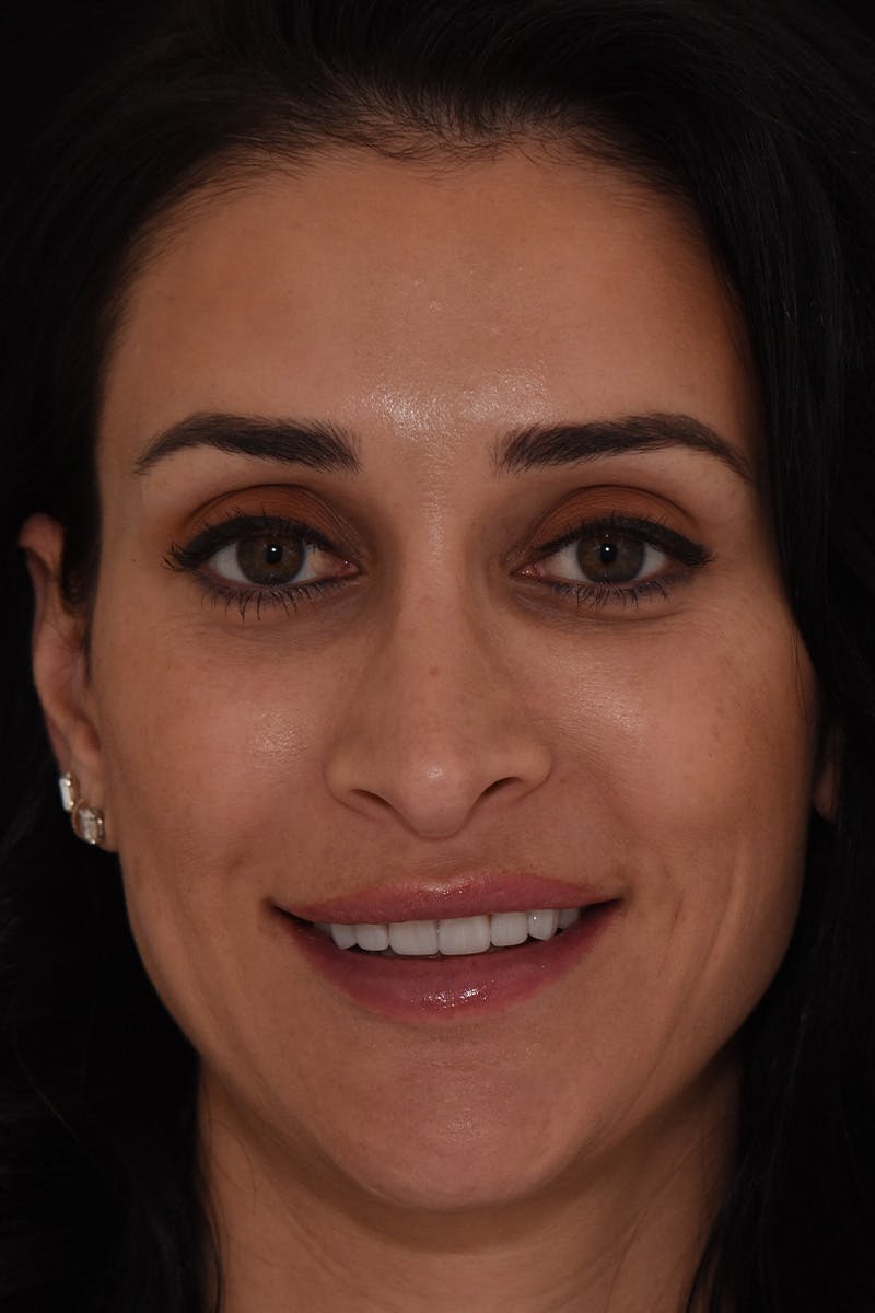 Patient Smile Before & After Gallery - Patient 371725 - Image 2