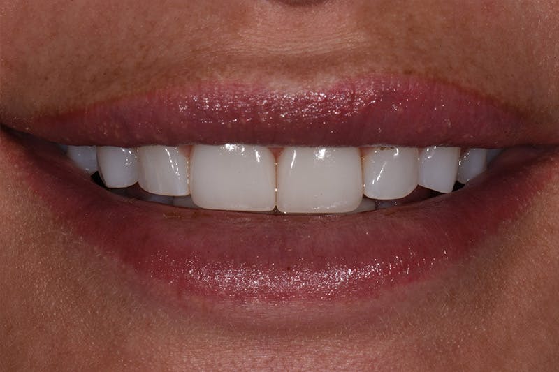 Patient Smile Before & After Gallery - Patient 371725 - Image 3