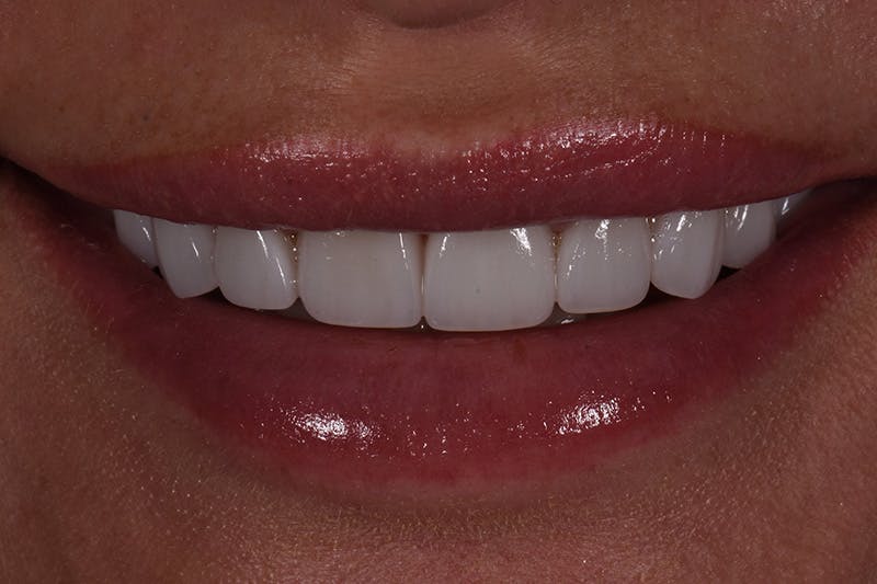 Patient Smile Before & After Gallery - Patient 371725 - Image 4