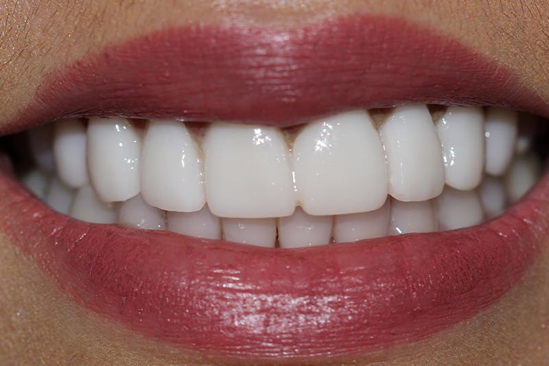 Patient Smile Before & After Gallery - Patient 227644 - Image 1