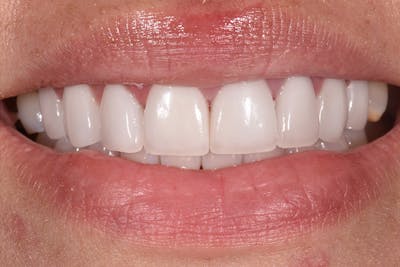 Patient Smile Before & After Gallery - Patient 227644 - Image 2
