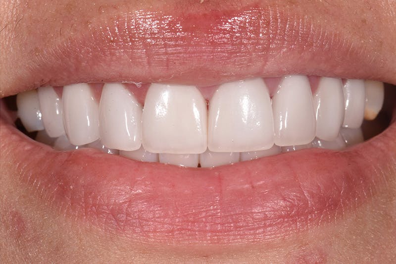 Patient Smile Before & After Gallery - Patient 227644 - Image 2