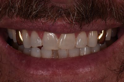 Patient Smile Before & After Gallery - Patient 627381 - Image 1