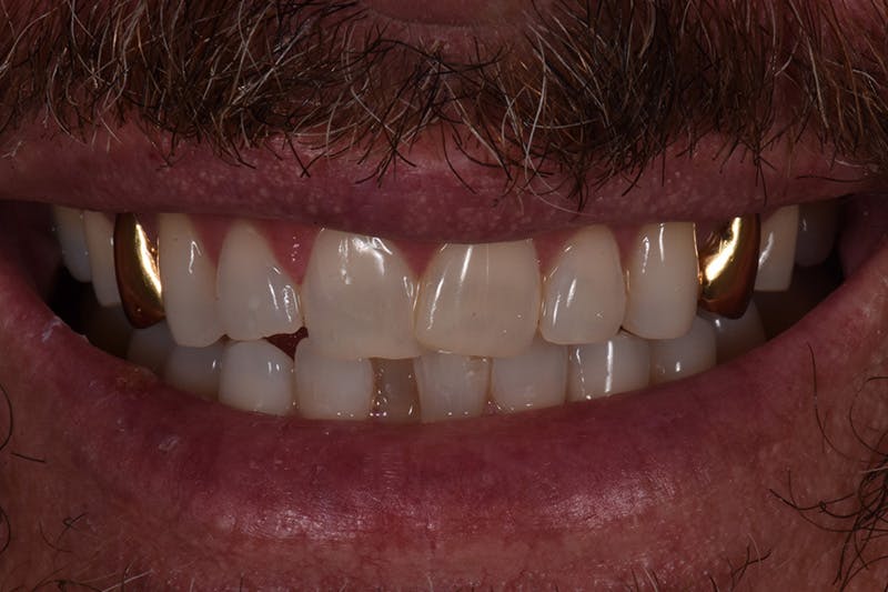 Patient Smile Before & After Gallery - Patient 627381 - Image 1