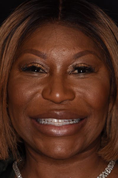Patient Smile Before & After Gallery - Patient 338434 - Image 1