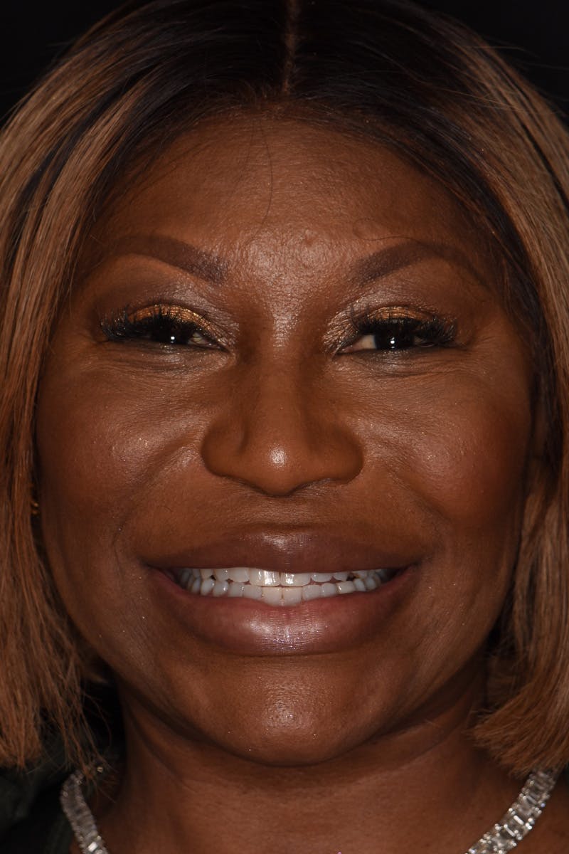 Patient Smile Before & After Gallery - Patient 338434 - Image 1