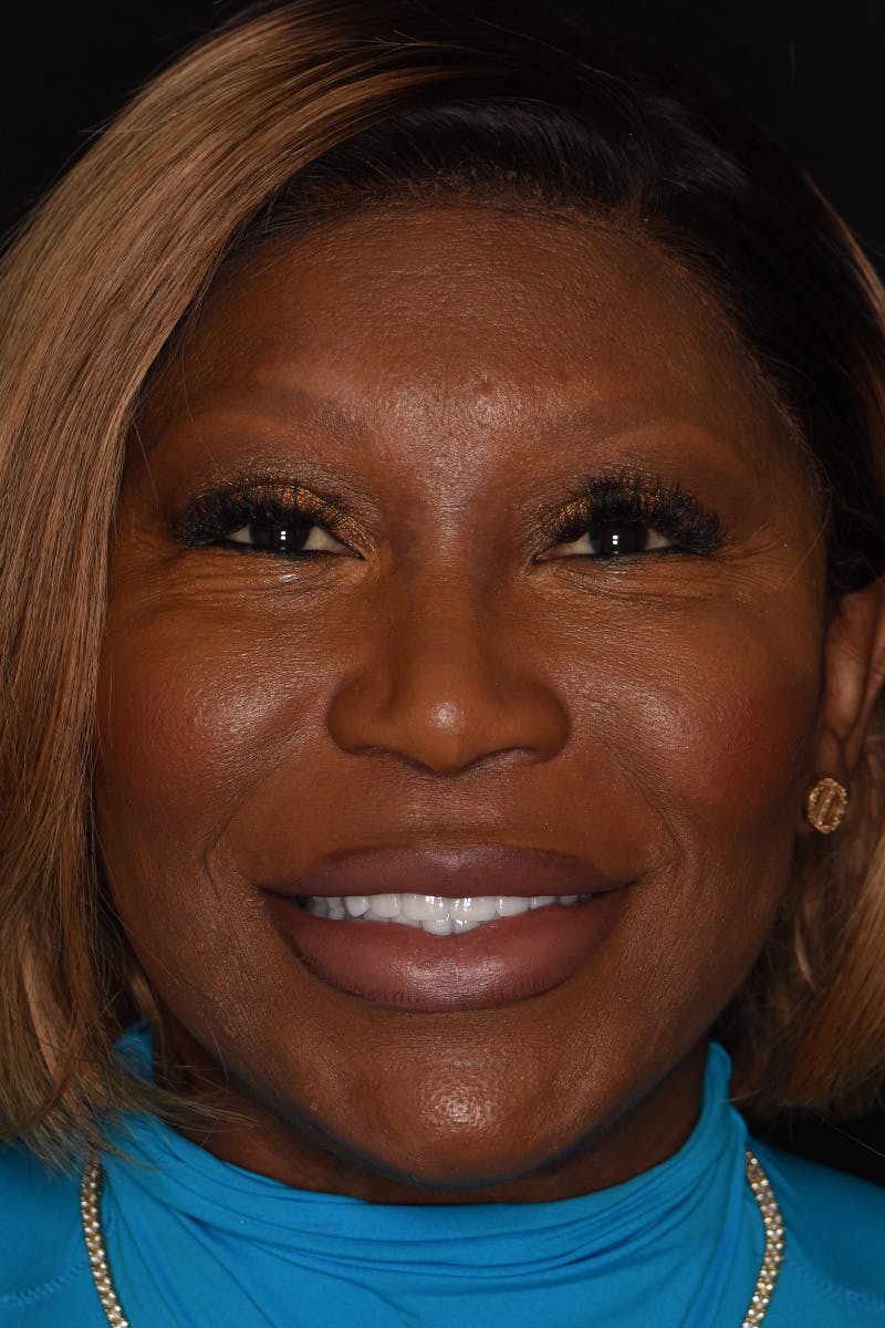 Patient Smile Before & After Gallery - Patient 338434 - Image 2