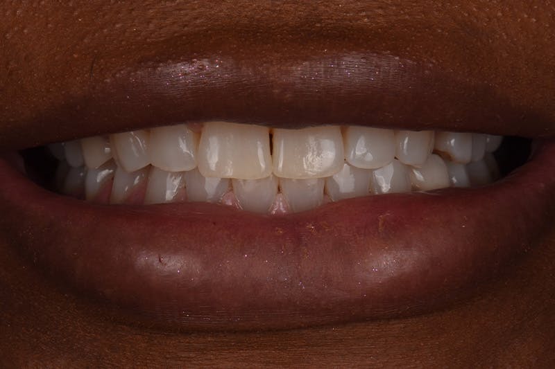 Patient Smile Before & After Gallery - Patient 338434 - Image 3