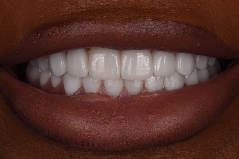 Patient Smile Before & After Gallery - Patient 338434 - Image 4