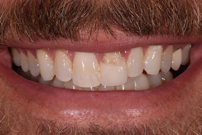 Patient Smile Before & After Gallery - Patient 338307 - Image 1