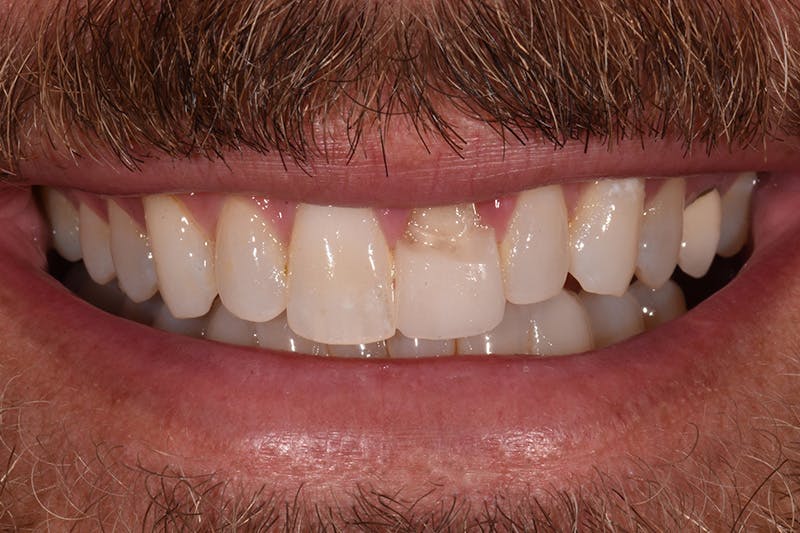 Patient Smile Before & After Gallery - Patient 338307 - Image 1