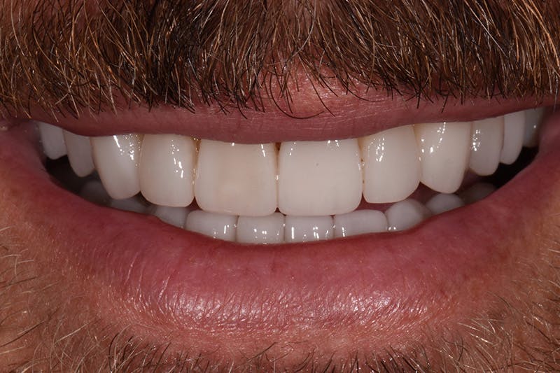 Patient Smile Before & After Gallery - Patient 338307 - Image 2