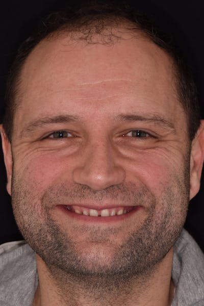 Patient Smile Before & After Gallery - Patient 243905 - Image 1
