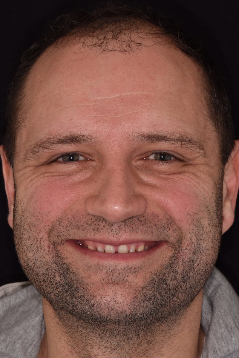 Patient Smile Before & After Gallery - Patient 243905 - Image 1