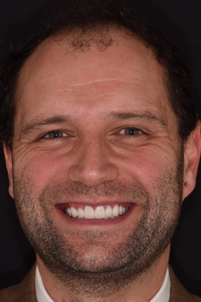 Patient Smile Before & After Gallery - Patient 243905 - Image 2