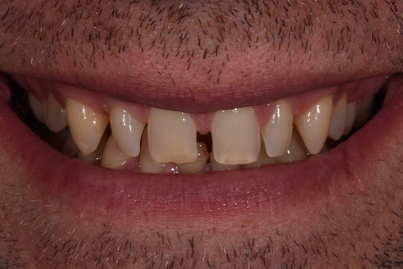 Patient Smile Before & After Gallery - Patient 243905 - Image 3