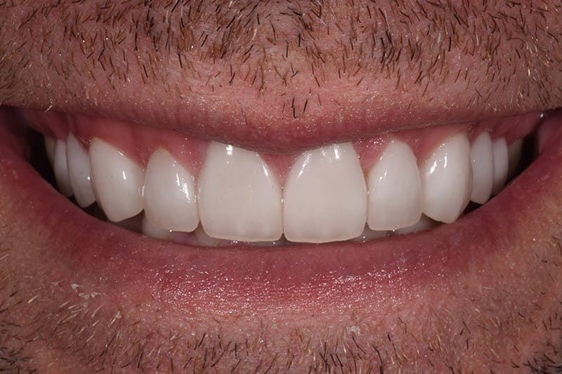 Patient Smile Before & After Gallery - Patient 243905 - Image 4