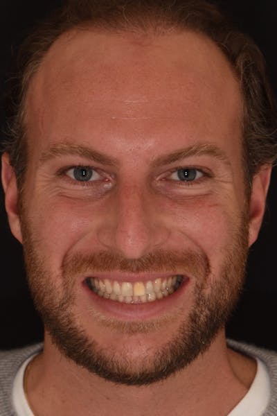 Patient Smile Before & After Gallery - Patient 881689 - Image 1