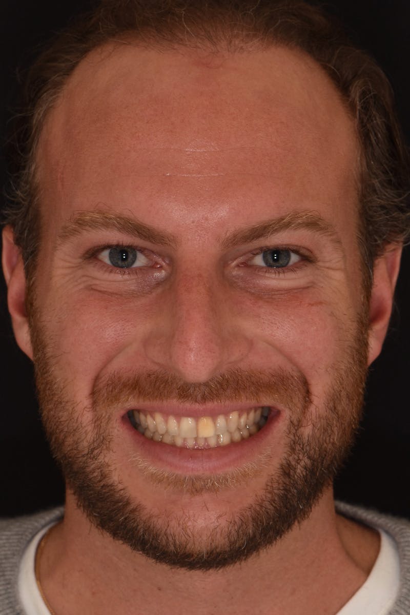 Patient Smile Before & After Gallery - Patient 881689 - Image 1