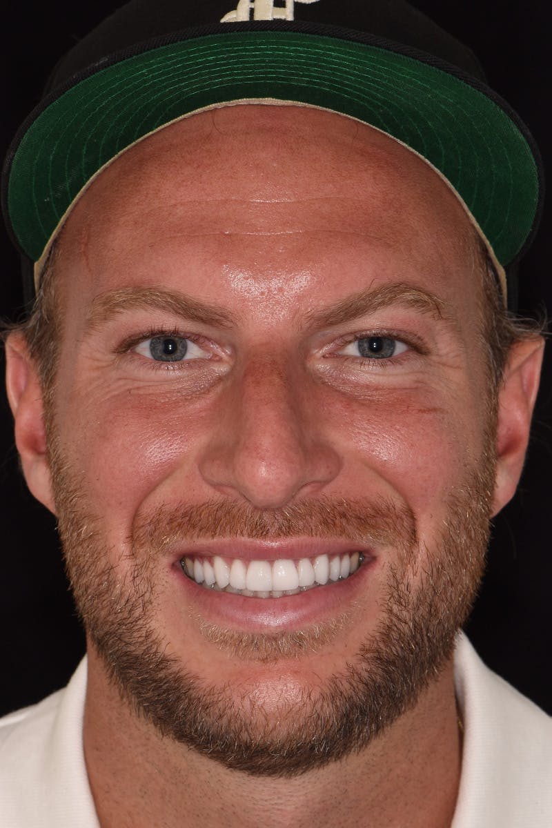 Patient Smile Before & After Gallery - Patient 881689 - Image 2