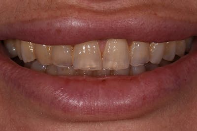 Patient Smile Before & After Gallery - Patient 127523 - Image 1
