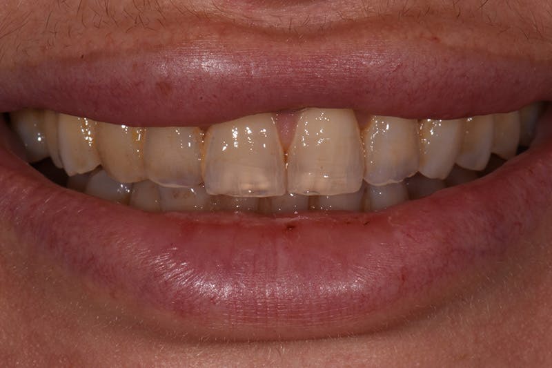 Patient Smile Before & After Gallery - Patient 127523 - Image 1