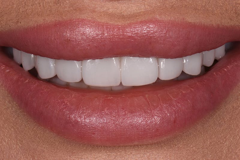 Patient Smile Before & After Gallery - Patient 127523 - Image 2