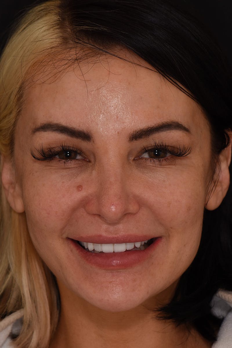 Patient Smile Before & After Gallery - Patient 303459 - Image 1