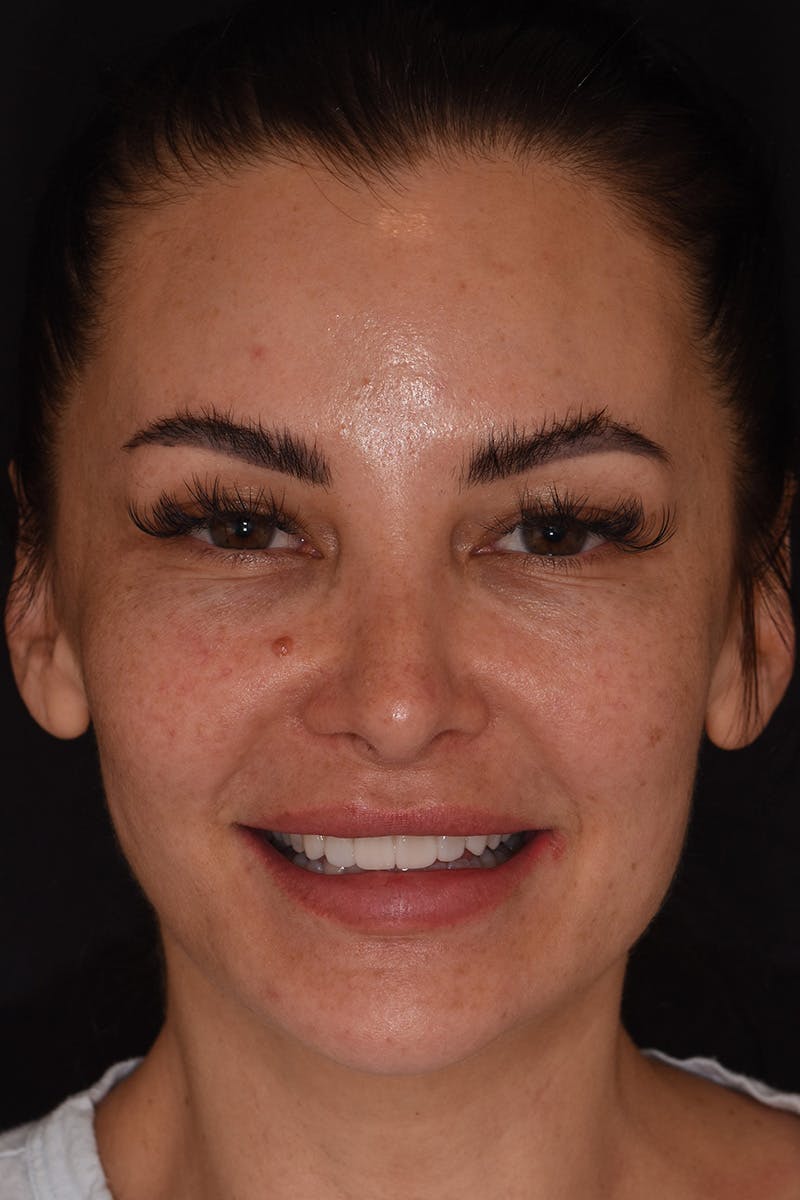 Patient Smile Before & After Gallery - Patient 303459 - Image 2