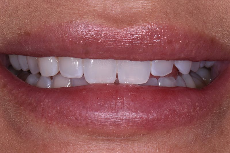 Patient Smile Before & After Gallery - Patient 303459 - Image 3